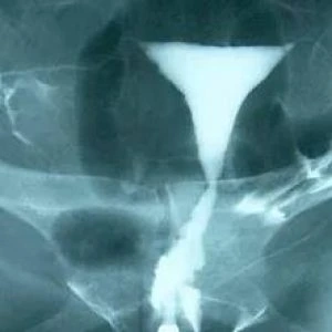 Κλασική σαλπιγγογραφία