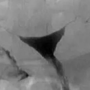 Κλασική σαλπιγγογραφία